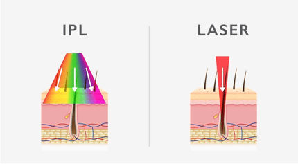 luz pulsada vs laser